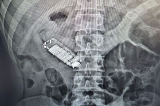 Preso com telefone na barriga.jpg
